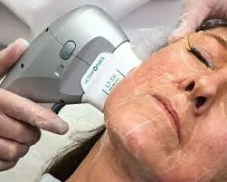 Tratamiento para eliminar papada: luz, firmeza y armonía facial